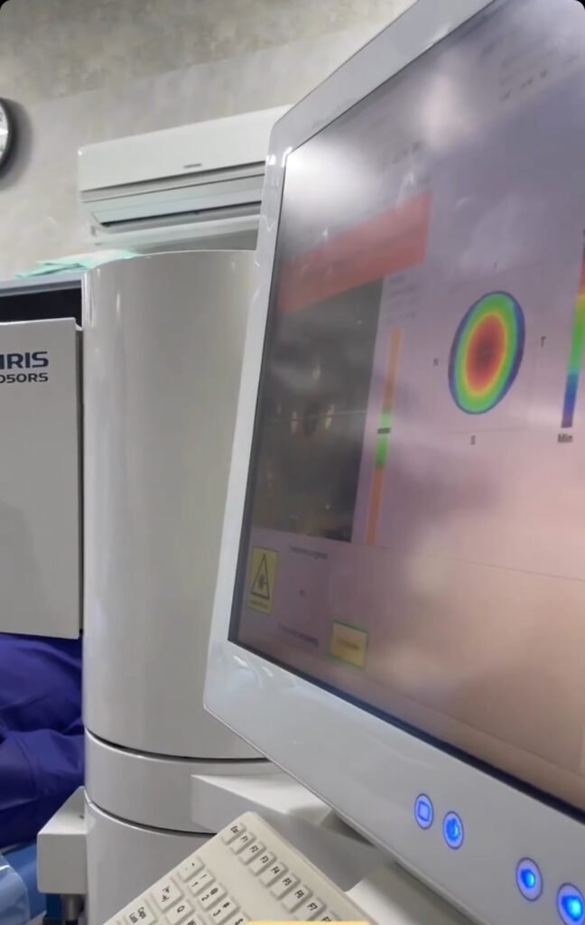 Monitor showing the procedure of refractive error surgery